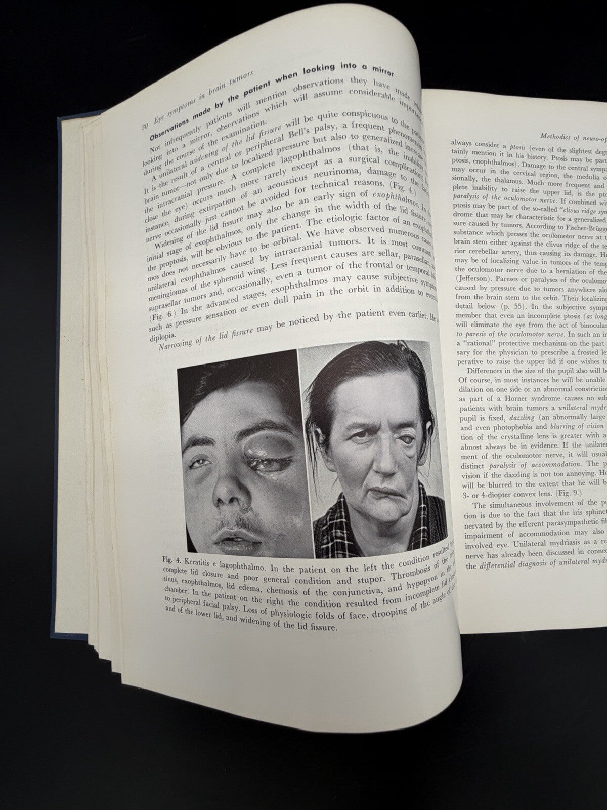 Eye Symptoms in Brain Tumors 1961 Alfred Huber MD Medical Ophthalmology Textbook
