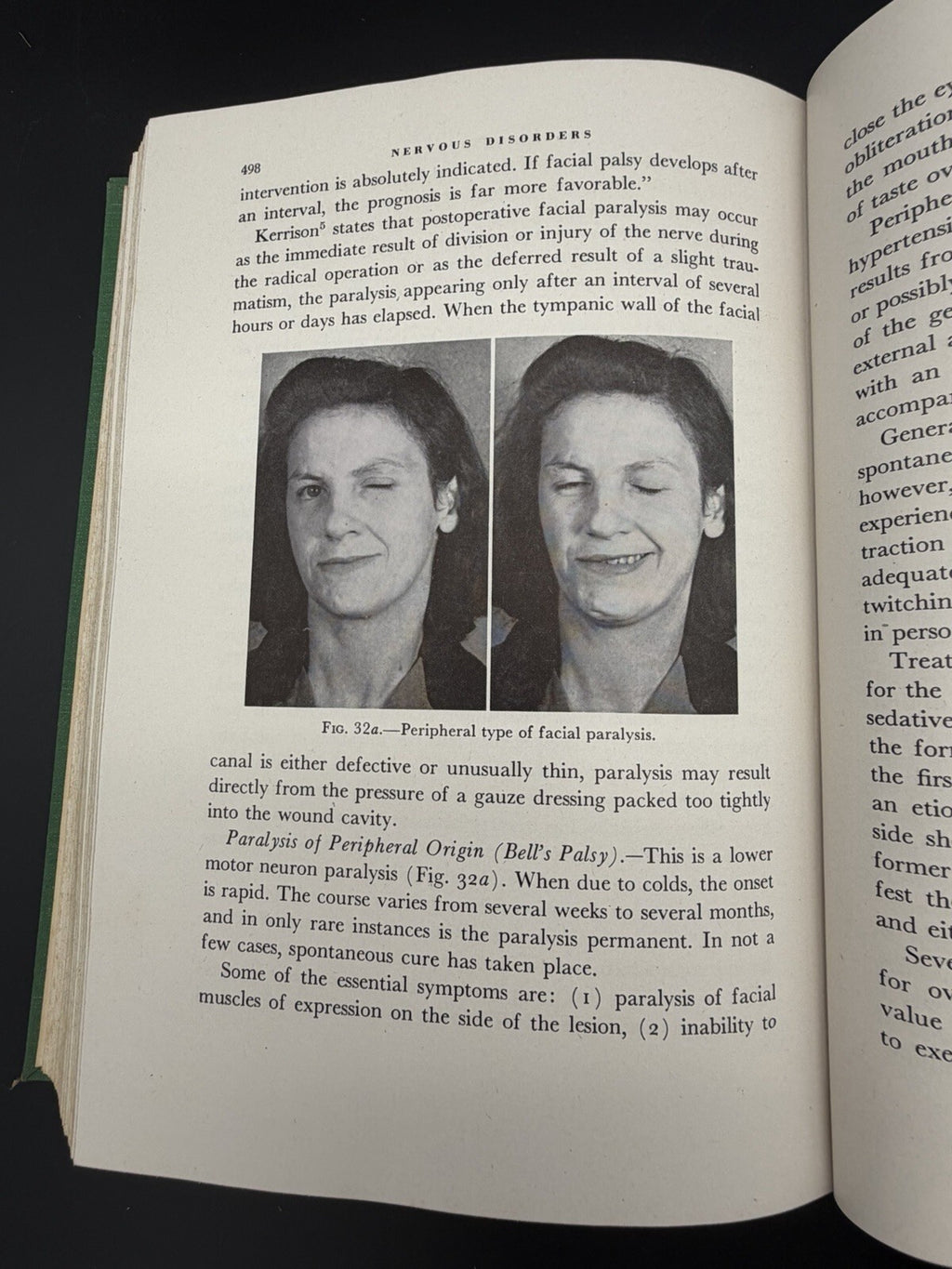 1946 Office Treatment of the Nose Throat & Ear Abraham R. Hollender 2nd Edition