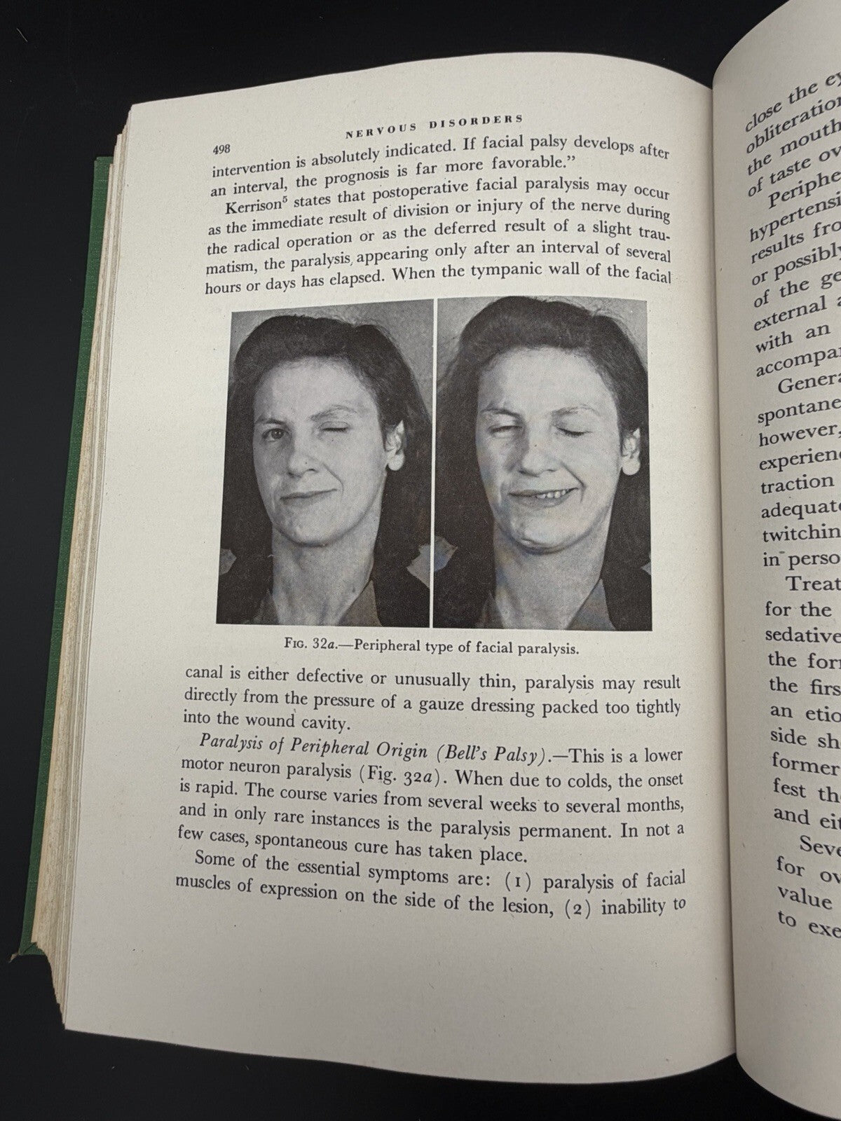 1946 Office Treatment of the Nose Throat & Ear Abraham R. Hollender 2nd Edition