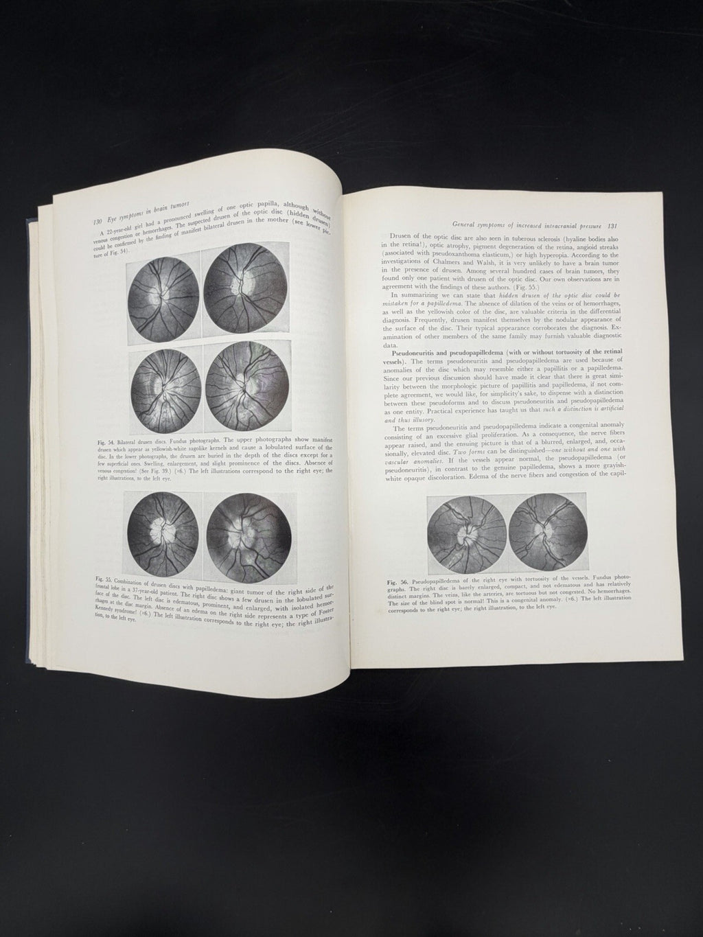 Eye Symptoms in Brain Tumors 1961 Alfred Huber MD Medical Ophthalmology Textbook