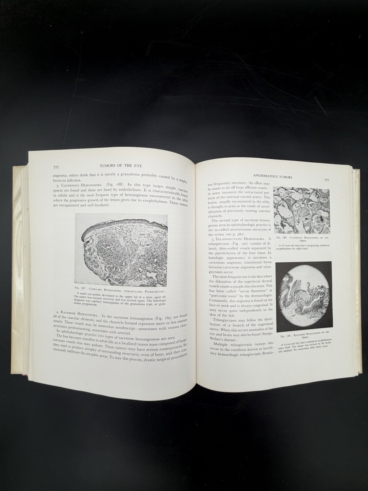 Vintage Book, 1951 Tumors of the Eye Algernon B Reese 1st Edition Dust Jacket Ephemera