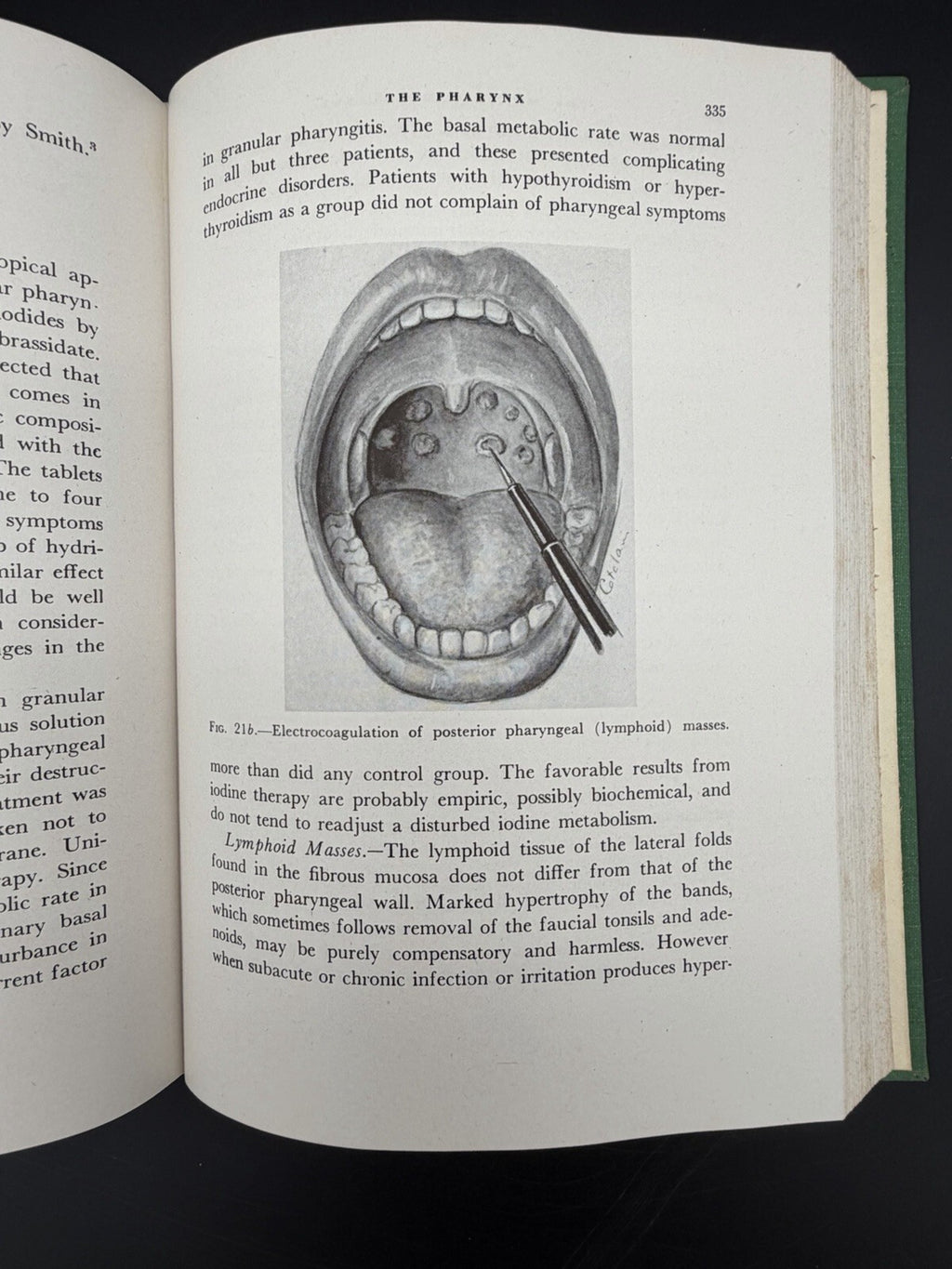 1946 Office Treatment of the Nose Throat & Ear Abraham R. Hollender 2nd Edition