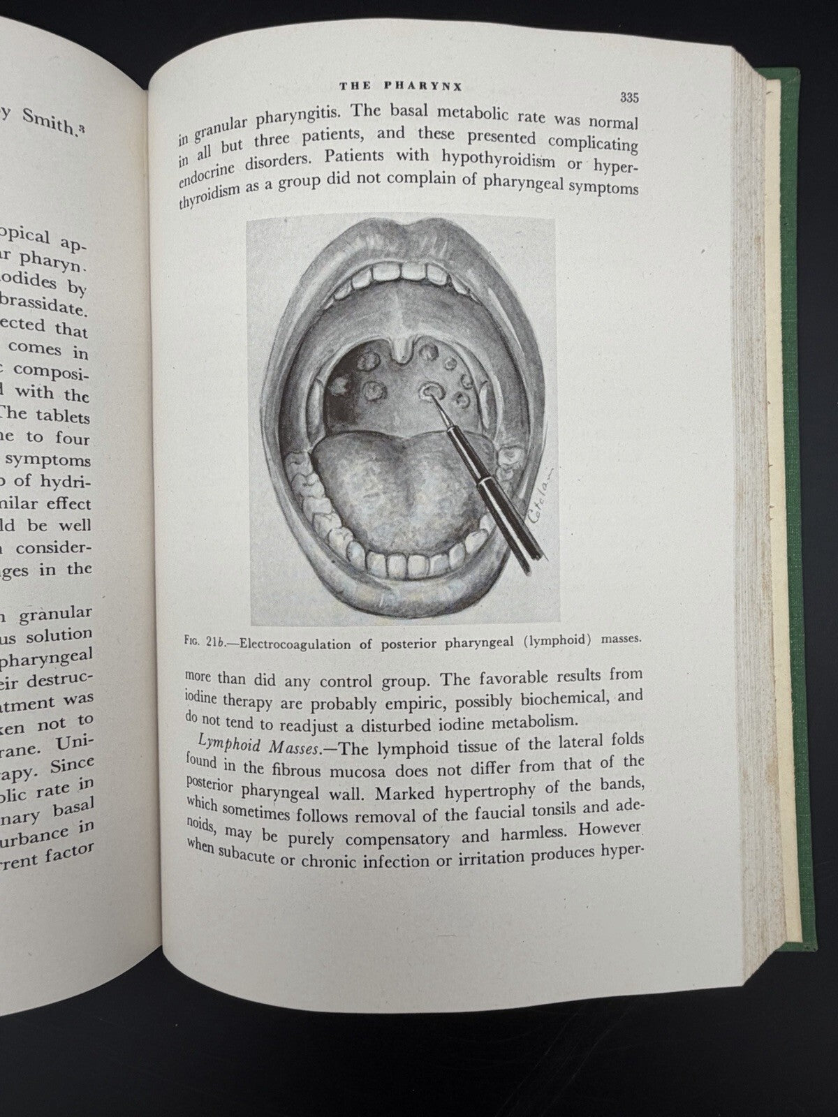 1946 Office Treatment of the Nose Throat & Ear Abraham R. Hollender 2nd Edition