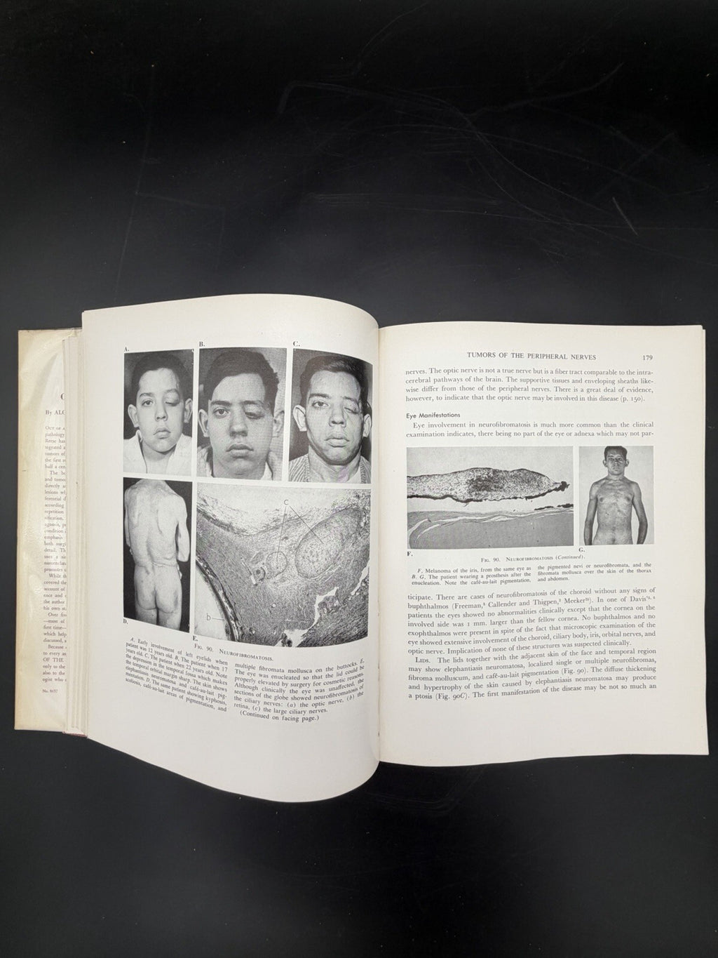 Vintage Book, 1951 Tumors of the Eye Algernon B Reese 1st Edition Dust Jacket Ephemera