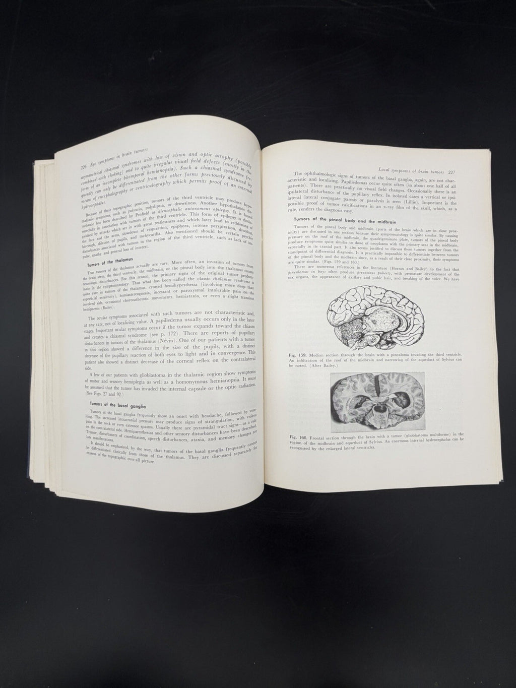 Eye Symptoms in Brain Tumors 1961 Alfred Huber MD Medical Ophthalmology Textbook
