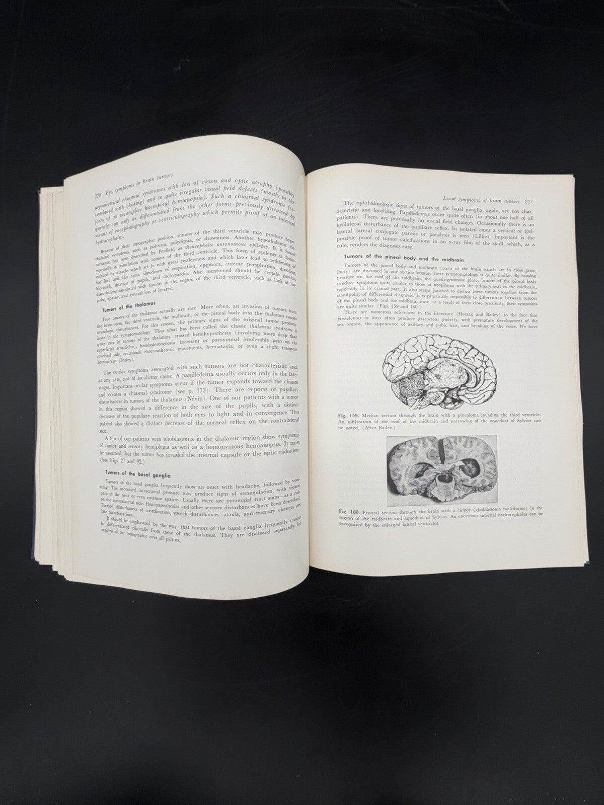 Eye Symptoms in Brain Tumors 1961 Alfred Huber MD Medical Ophthalmology Textbook