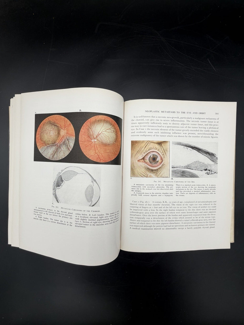 Vintage Book, 1951 Tumors of the Eye Algernon B Reese 1st Edition Dust Jacket Ephemera